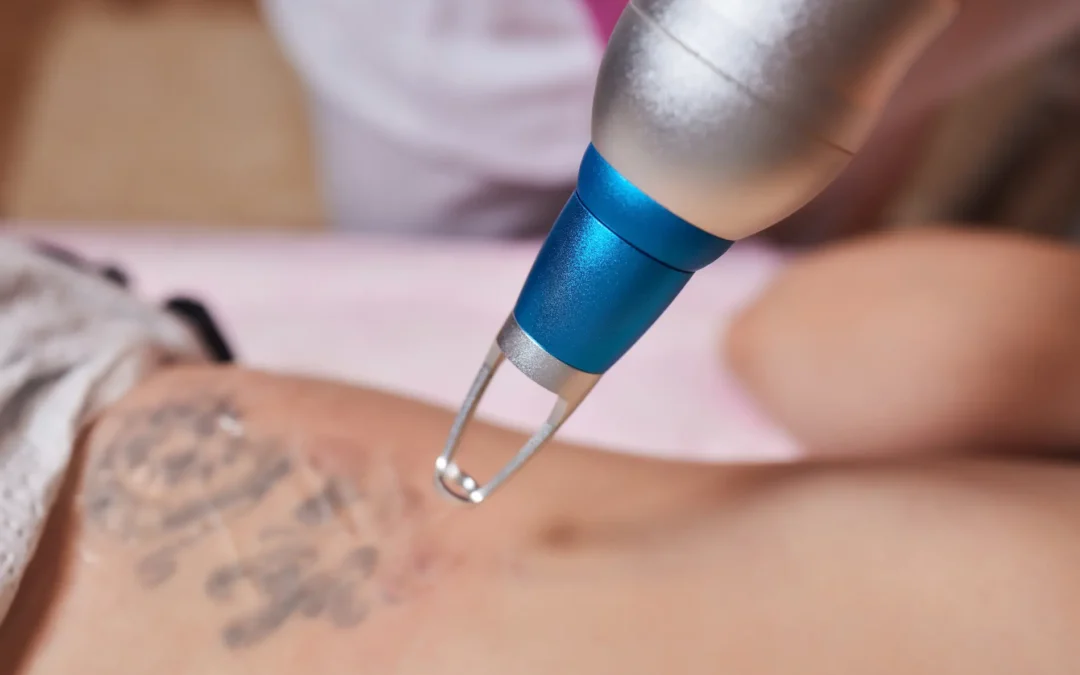 Laser Tattoo Removal Cost in Ann Arbor: How Much Does It Really Cost?