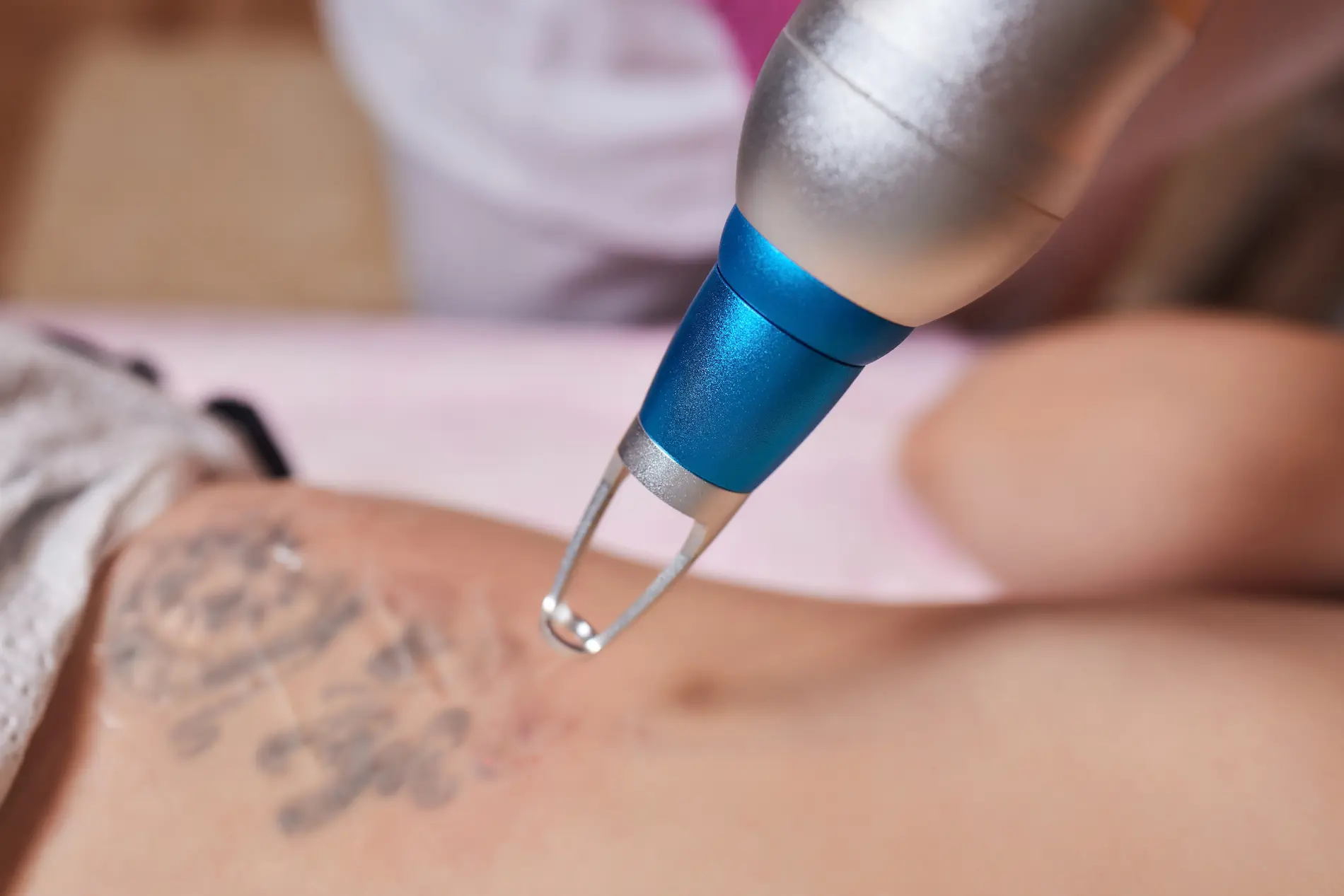 Laser tatto removal in ann arbor